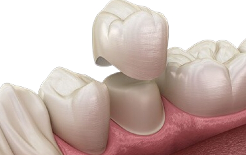 Zirconia Crown