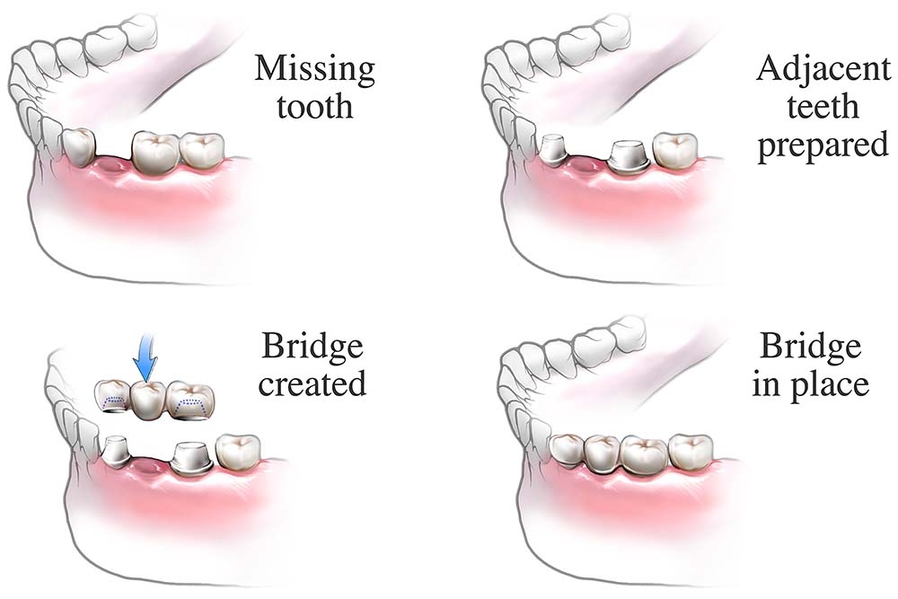 Types of Dental Bridges