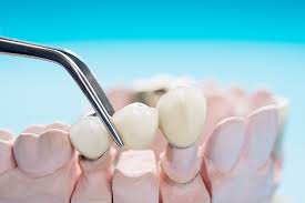 How Dental Bridges Work