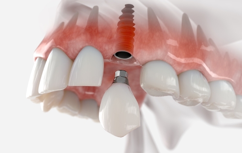 PFM Implant Crown